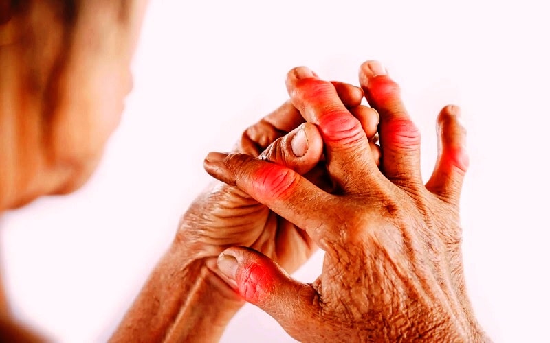 CBD Oil for Rheumatoid Arthritis