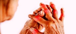 CBD Oil for Rheumatoid Arthritis